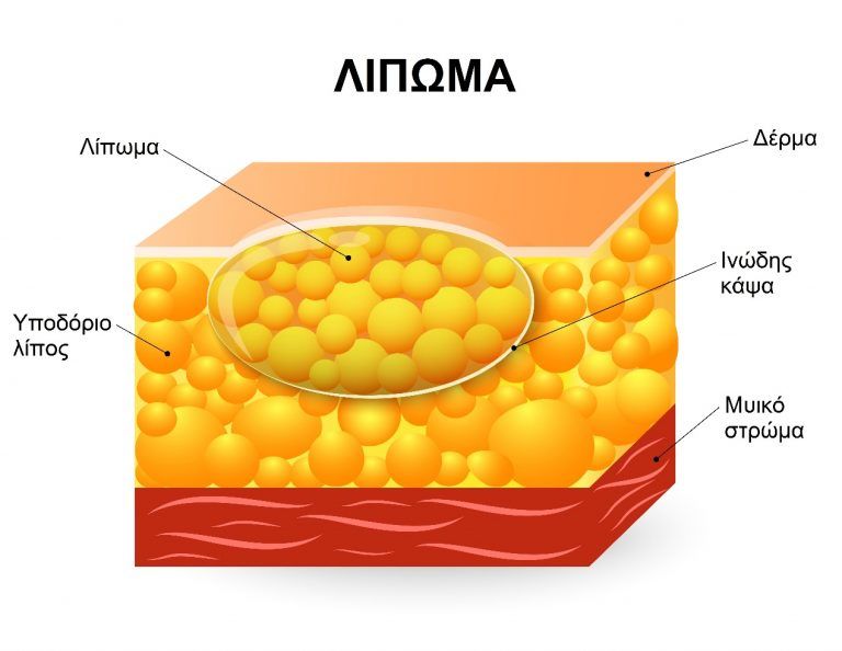 lipoma2