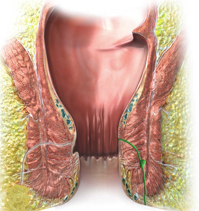 periedriko sirrigio 01