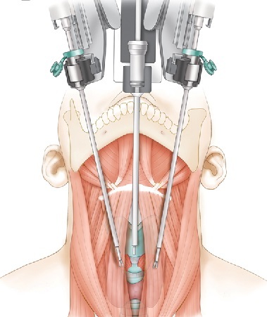 thyroeidis2